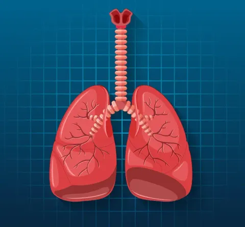 MAC Lung Disease: Guide to Symptoms, Causes, Diagnosis and Treatment